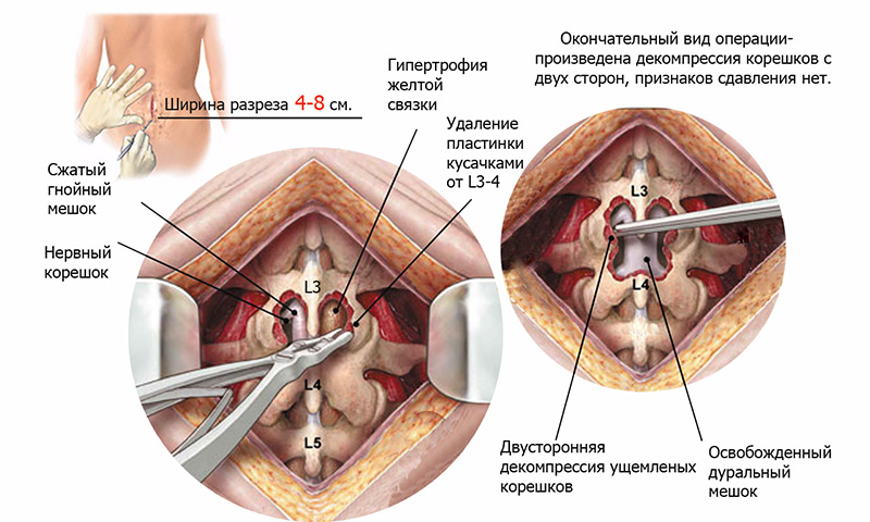 Риск паралича